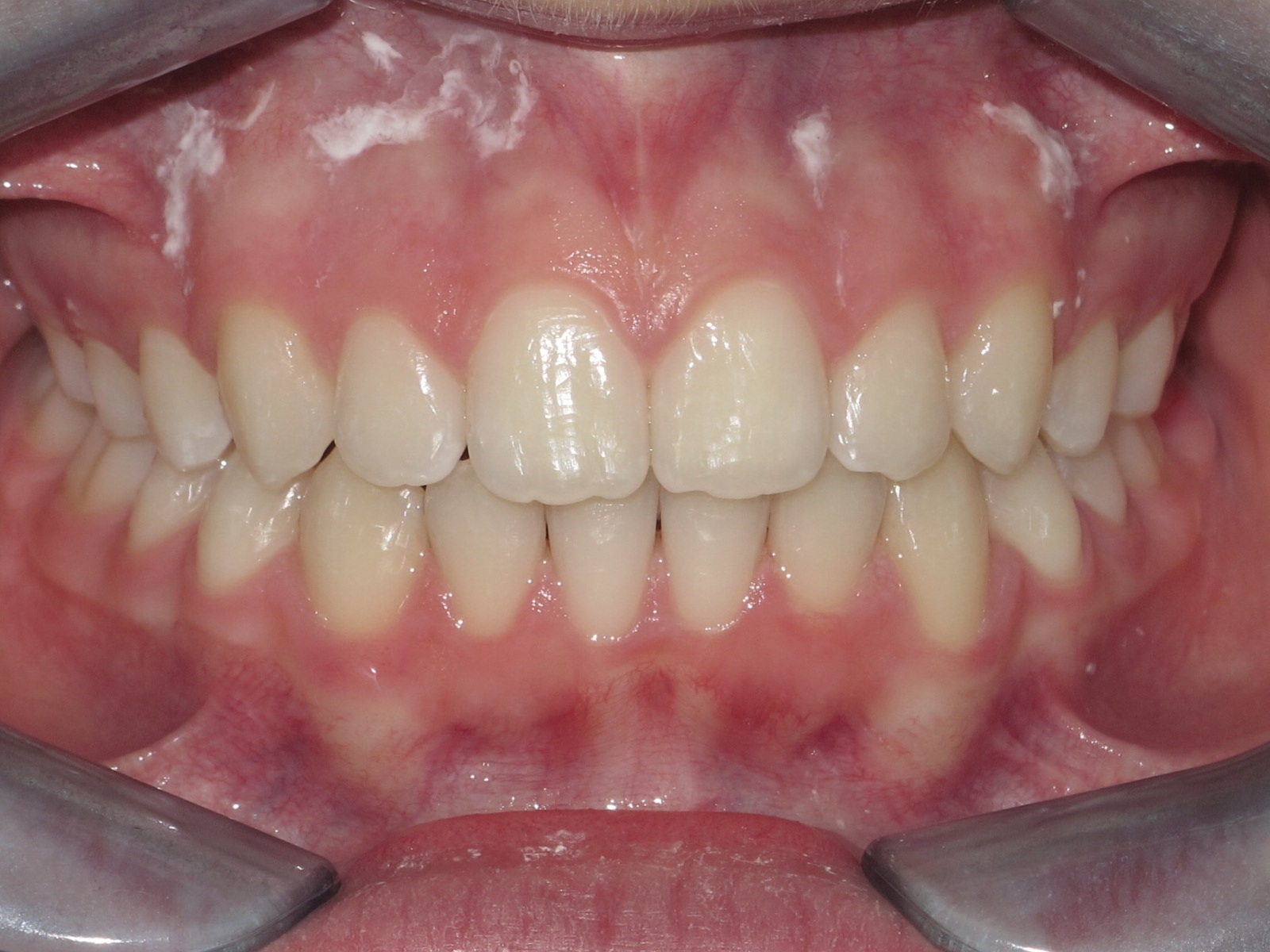 Case 1 after treatment